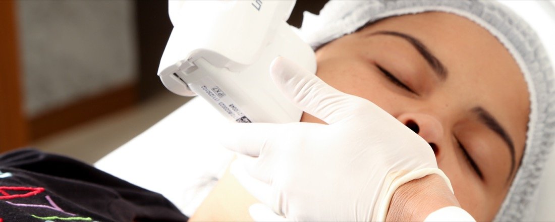 Aplicação de ultrassom microfocado Liftera no rosto da paciente