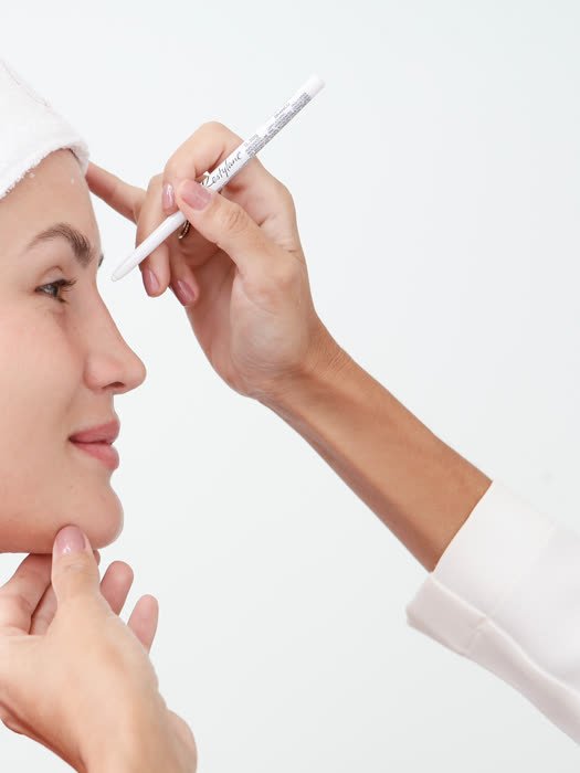 Marcação facial antes de aplicação de preenchimento com ácido hialurônico